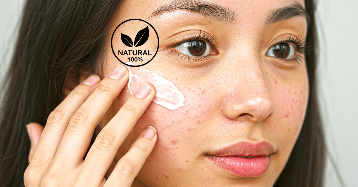 Treat Acne Naturally 10 Proven Home Remedies