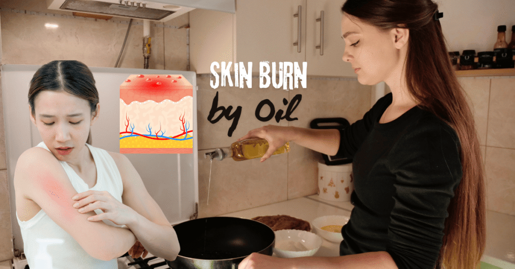 skin burn by oil