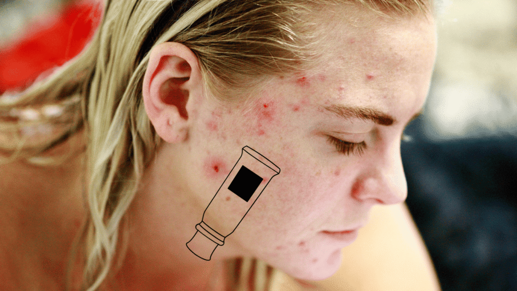 Side Effects of Pharma Creams Acne, Thinning & More Side Effects of Pharma Creams Acne, Thinning & More