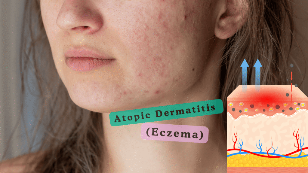 Atopic Dermatitis (Eczema) Signs, and Best Treatment Atopic Dermatitis (Eczema) Signs, and Best Treatment