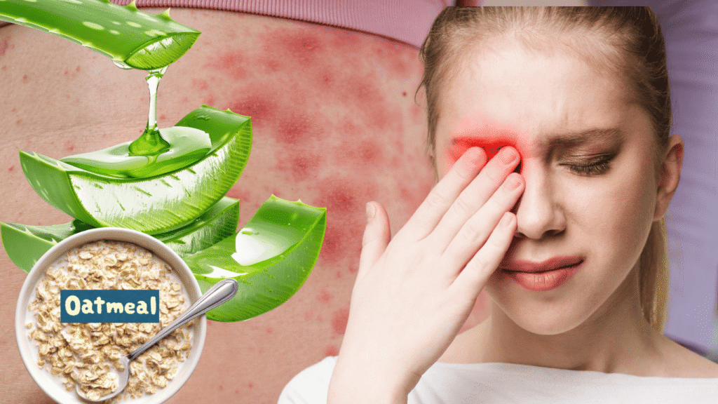 Urticaria Hives on Face Causes & Best Treatment natural Treatment of Urticaria (Hives) by Aloe vera gel and with oatmeal & coconut oil
